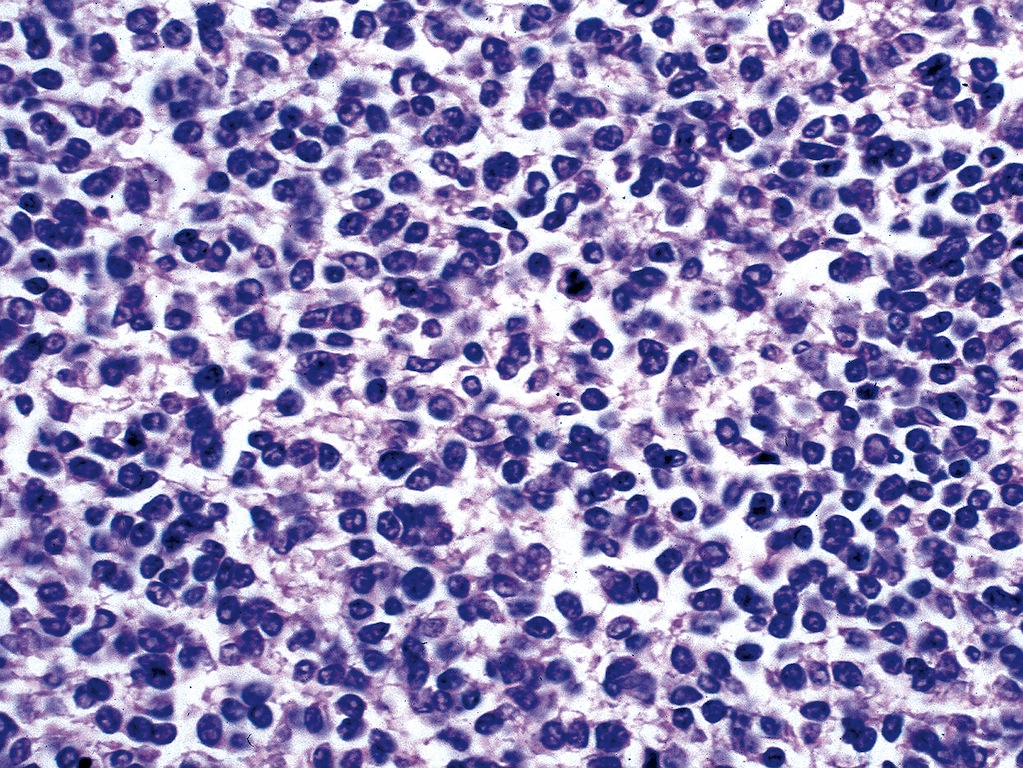 Pathology Outlines Metastases 